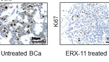 Images of estrogen receptor-positive (ER+) breast cancer with and without ERX-11.