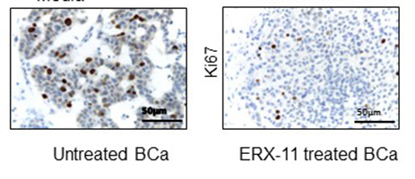 Images of estrogen receptor-positive (ER+) breast cancer with and without ERX-11.