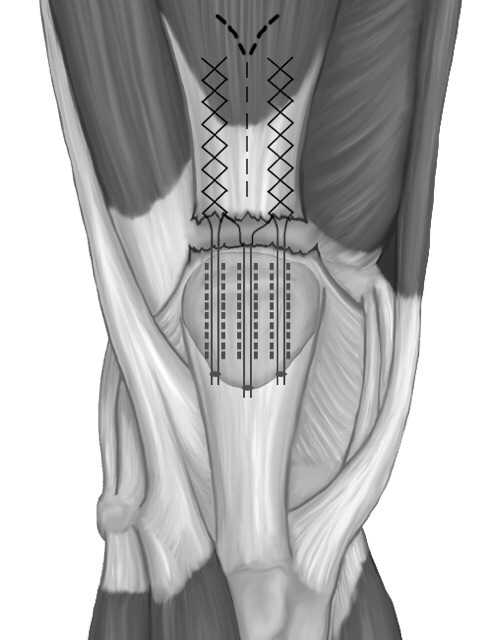 quadriceps tendon rupture