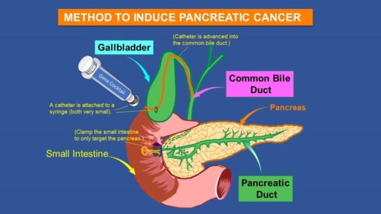 Injecting gene cocktail into mouse pancreas leaders to humanlike tumors