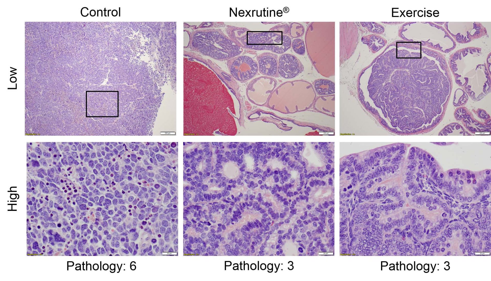 Cork tree bark extract, exercise each slow aggressive prostate cancer