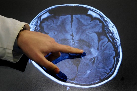 Scan of brain injury