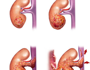 Four-panel illustration of kidney cancer