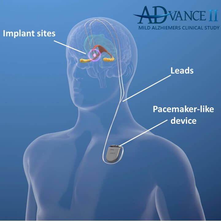 Graphic of location of deep brain stimulation device for Alzheimer's
