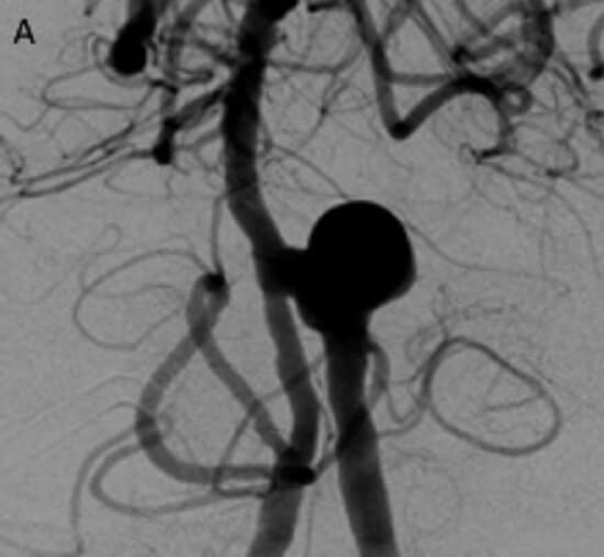 Image of an unruptured brain aneurysm