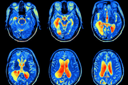 MRI scan image of brain