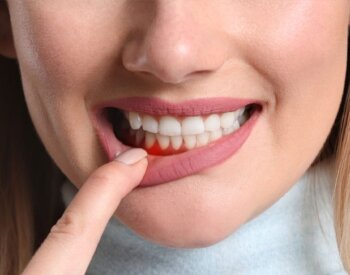 Woman bares teeth pointing to her inflammed gumline.