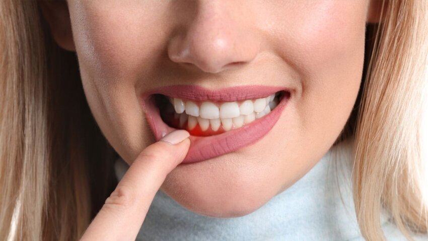 Woman bares teeth pointing to her inflammed gumline.