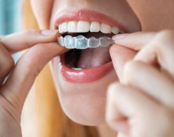 A female patient places a clear aligner in her mouth.
