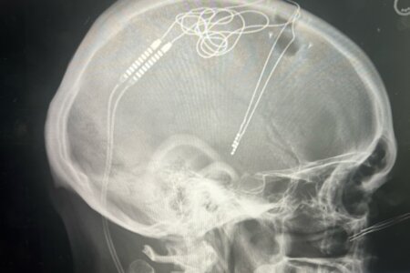 Black and white side view of brain with electrodes and wires.