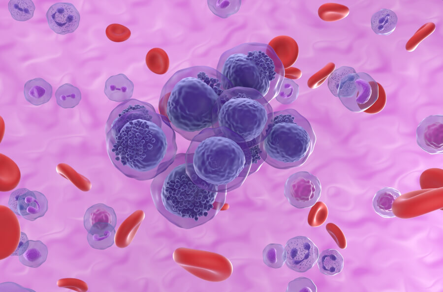 3D rendering of acute myeloid leukemia.