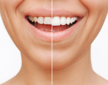 Cropped face shot of a young caucasian smiling woman before and after cosmetic dental treatment.