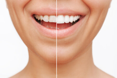 Cropped face shot of a young caucasian smiling woman before and after cosmetic dental treatment.