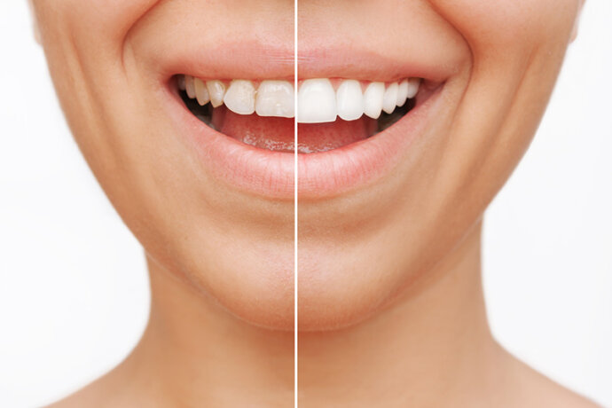 Cropped face shot of a young caucasian smiling woman before and after cosmetic dental treatment.
