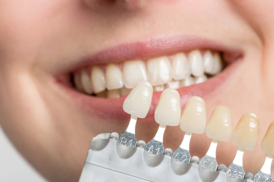Different color swatches of veneers are held up to a patient's natural teeth to determine the best color.